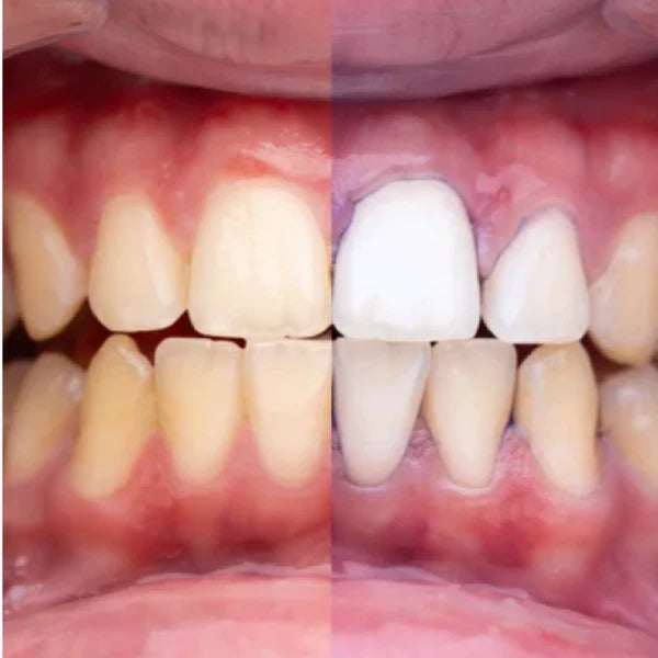 Blanqueador Dental Smilekit V34 - Dientes blancos en 1 minuto